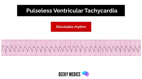 What Are Shockable Rhythms
