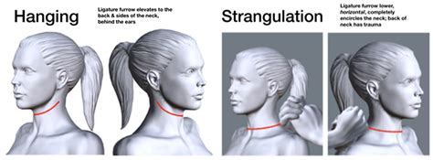 Image result for Postural Strangulation