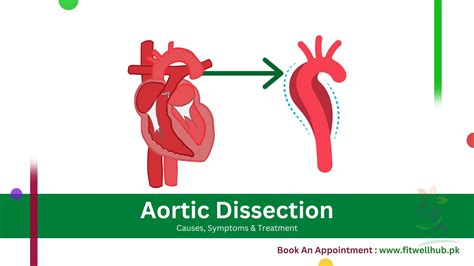 Aortic Dissection | Causes, Symptoms and Treatment Guide