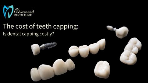Cost of Teeth Capping: The Dental Caps Cost to Value Relation - Advanced Dental Clinic East Delhi