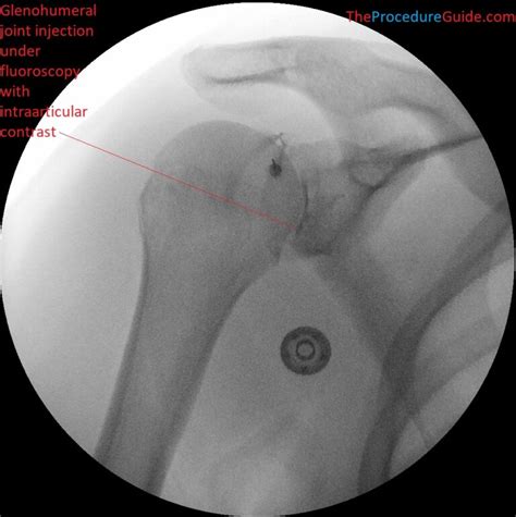 Fluoroscopy Injection 的图像结果