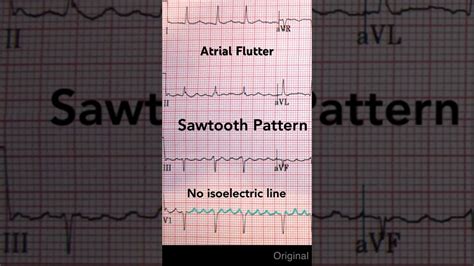 Image result for Atrial Flutter ECG Pattern