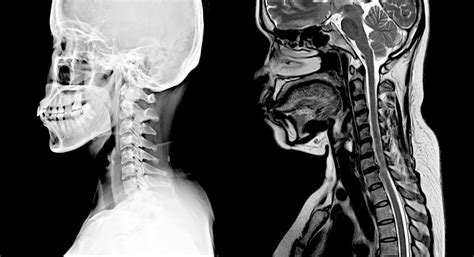 Cervical Spine Mri