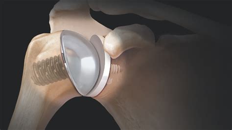 How Successful Is Total Shoulder Replacement Surgery at Steven Dietz blog
