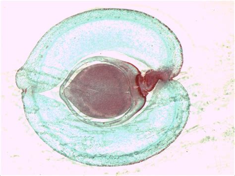 UP: 'Genetically Male' Woman Having Non-Functional Ovaries Gives Birth ...