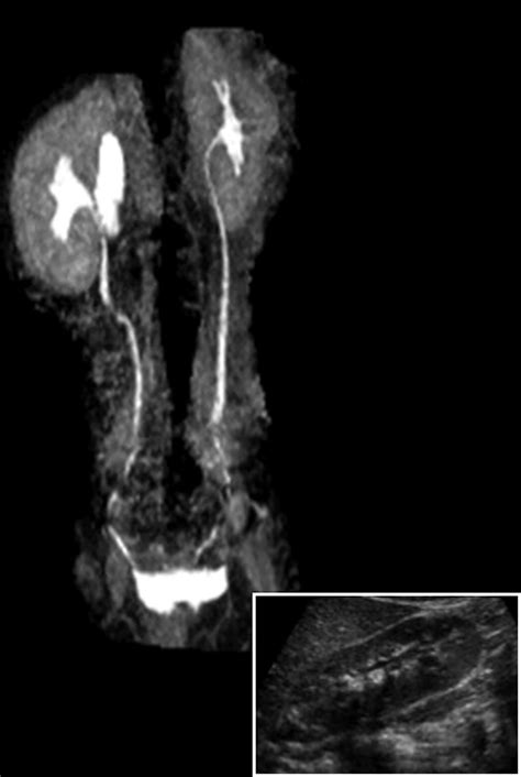 Voiding Dysfunction: What Can Radiologists Tell Patients and Pediatric ...