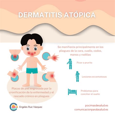 Dermatititis atópica: Causas, síntomas y tratamientos que debes conocer ...