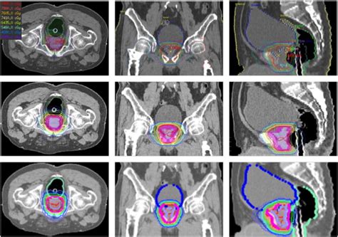 Prostate Radiation Simulation 的图像结果