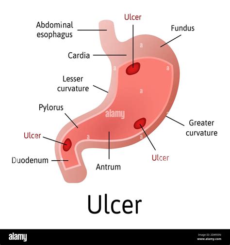 Gastric Ulcer Types