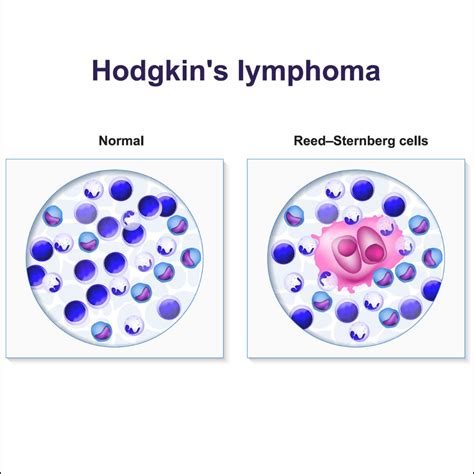 Hodgkin Lymphoma: Causes, Risk Factors, Symptoms, Treatment
