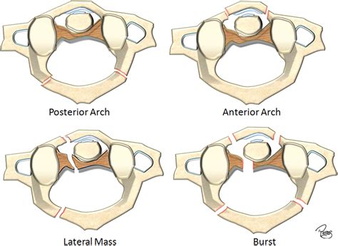 Imaging of Atlanto-Occipital and Atlantoaxial Traumatic Injuries: What ...