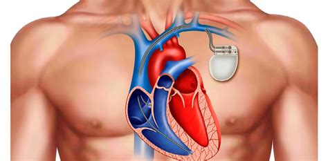 Image result for Installing Pacemaker