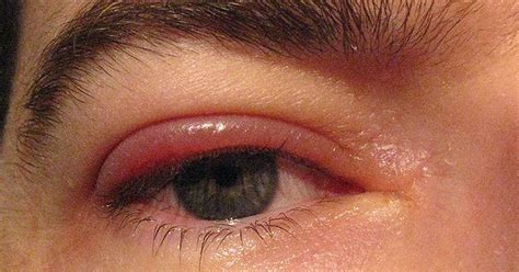 Eyelid Disease Blepharitis