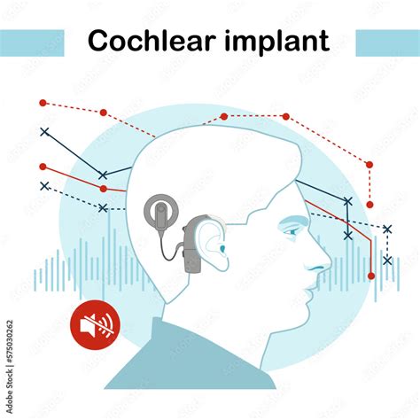 Image result for Cochlear