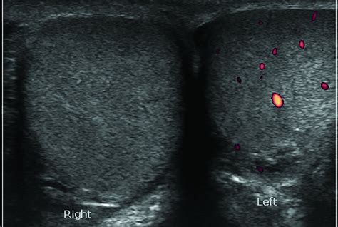 Imaging Testicular Torsion | Applied Radiology