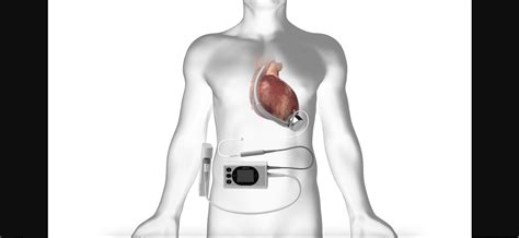 Surgeons make history with first US implant of new magnetically suspended heart pump