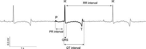 Image result for R-R Interval Calculation for ECG Code in Python