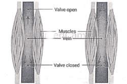 Varicose Veins - Medical Science Optional Notes for UPSC PDF Download
