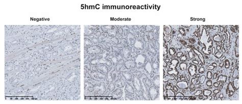 5hmC Level Predicts Biochemical Failure Following Radical Prostatectomy ...