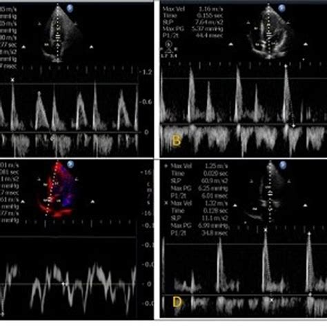 Image result for Grading Diastolic Dysfunction