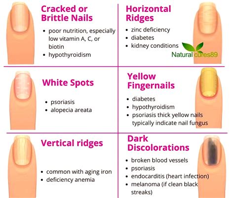 48 Nails Zinc Deficiency | Noviyandipainter