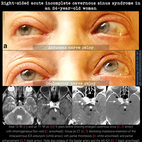 Cavernous Sinus Syndrome