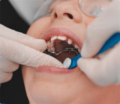 Invisalign Expander 的图像结果