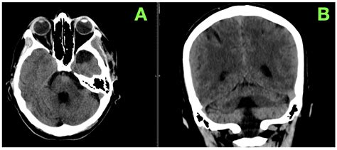 Large Pontine Cavernoma with Hemorrhage: Case Report on Surgical Approach and Recovery - hemorrhage in pons