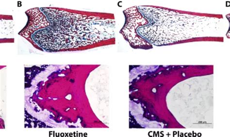 Depression and fluoxetine may negatively impact BMD and implant ...