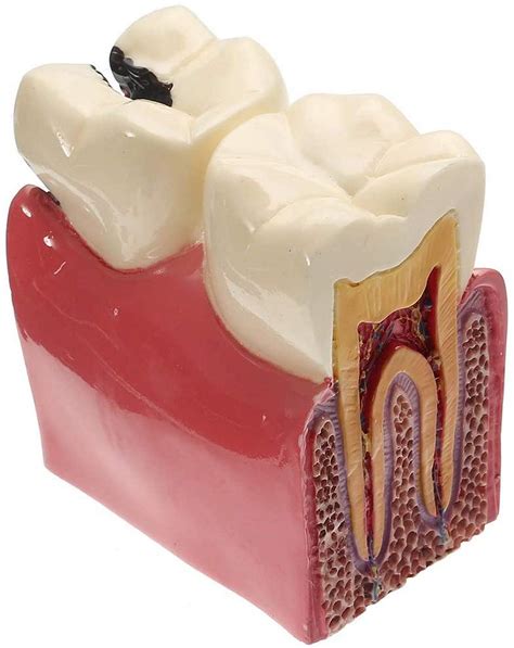 Qtww Dental Caries Tooth Model Diseased Teeth Dental Patient Education ...