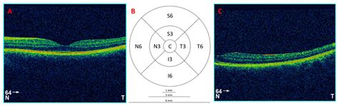 Adaptive Illuminance Effects on Retinal Morphology and Refraction: A ...