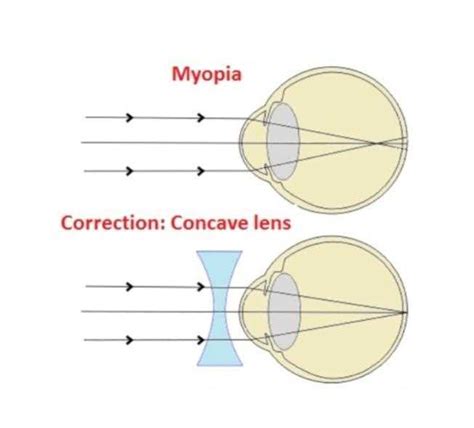 An Illustrated Explanation of Myopia: Understanding the Ray Diagram