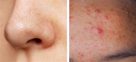 ThriveCo Goodbye Acne Kit with Facial Cleanser & Face Serum