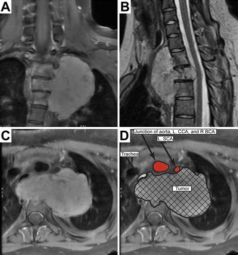Image result for Clamshell Thoracotomy Cartoon