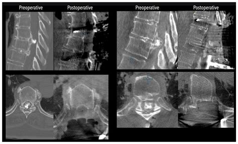 Transpedicular Transdural Approach for Calcified Thoracic Disc ...