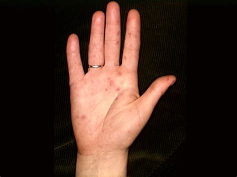 herpes on palm of hands - pictures, photos