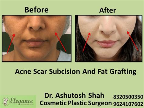 Acne Scar Subcision Fat Grafting Surgery, Acne Treatment in Vesu, Surat