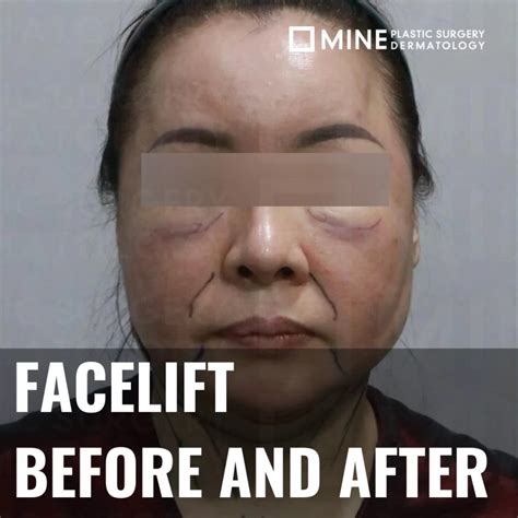 Salivary Gland Botox and side effects | MINE Plastic Surgery