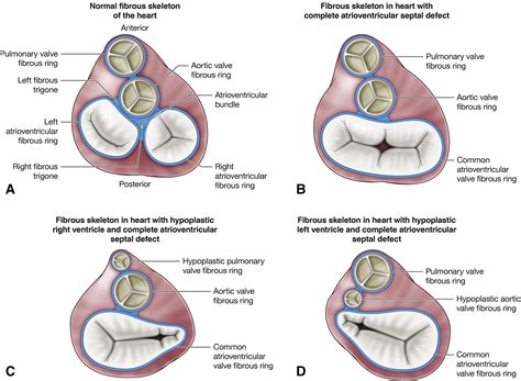 Atrioventricular valve surgery: Restoration of the fibrous skeleton of ...