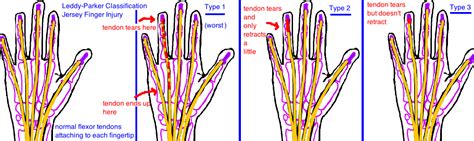 Image result for Leddy Packer Classification Table