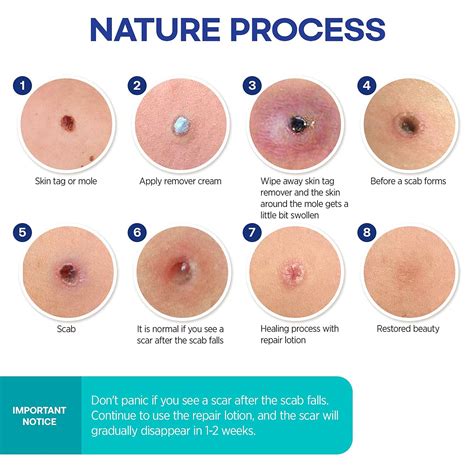 Buy Skin Tag Removal Treatment-Skin Tag Remover-Made of Natural Plant ...