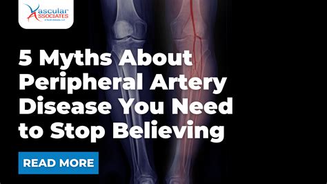 Vascular Associates Blog | 5 Myths About Peripheral Artery Diseas