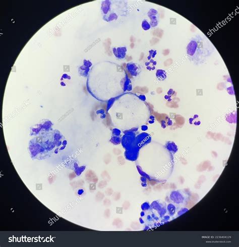 Signet Ring Cell Like Macrophage Cell Stock Photo 2236404129 | Shutterstock