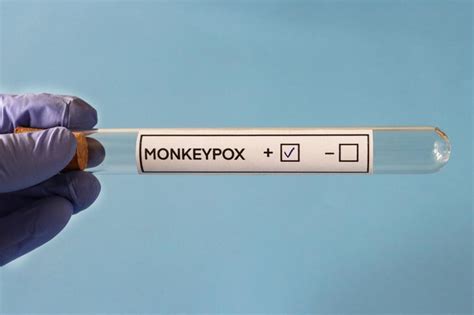 Current monkeypox symptoms are different from previous outbreaks, finds ...