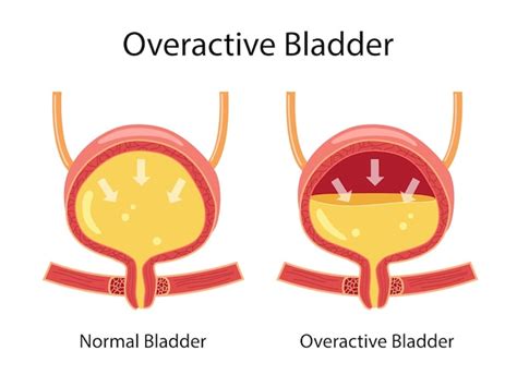 Comparing normal and overactive bladder anatomy urinary incontinence ...