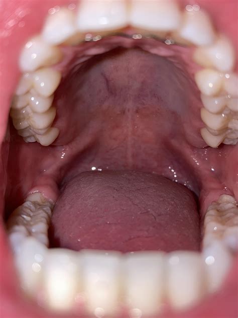 Mouth Roof Scratch at Norman Nelson blog