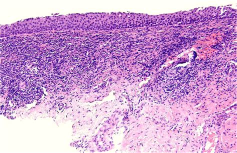 Erosive vulval lichen planus—a diagnosis not to be missed: a clinical review - European Journal ...