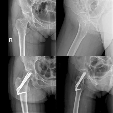 Impacted Fracture Femur