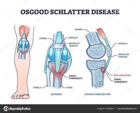 Osgood Schlatter Knee