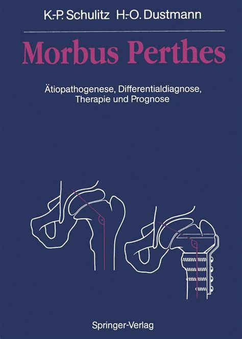 Buy Morbus Perthes Book Online at Low Prices in India | Morbus Perthes ...